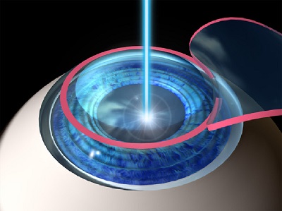 Laser Eye surgery
