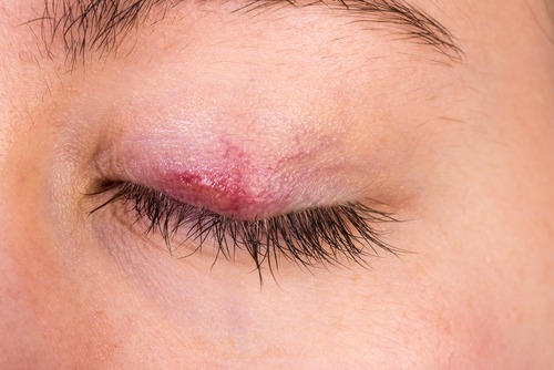 what is a chalazion